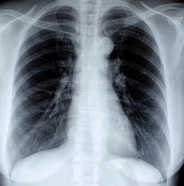 Рентген грудного отдела позвоночника