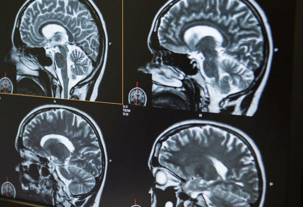 Магнитно-резонансная (МР) трактография мозга