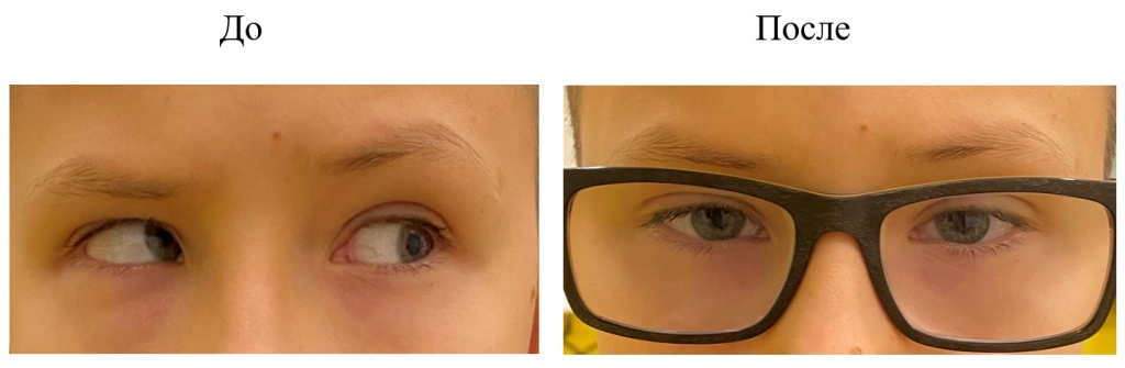 Хирургия частично-аккомодационного косоглазия-5.jpg