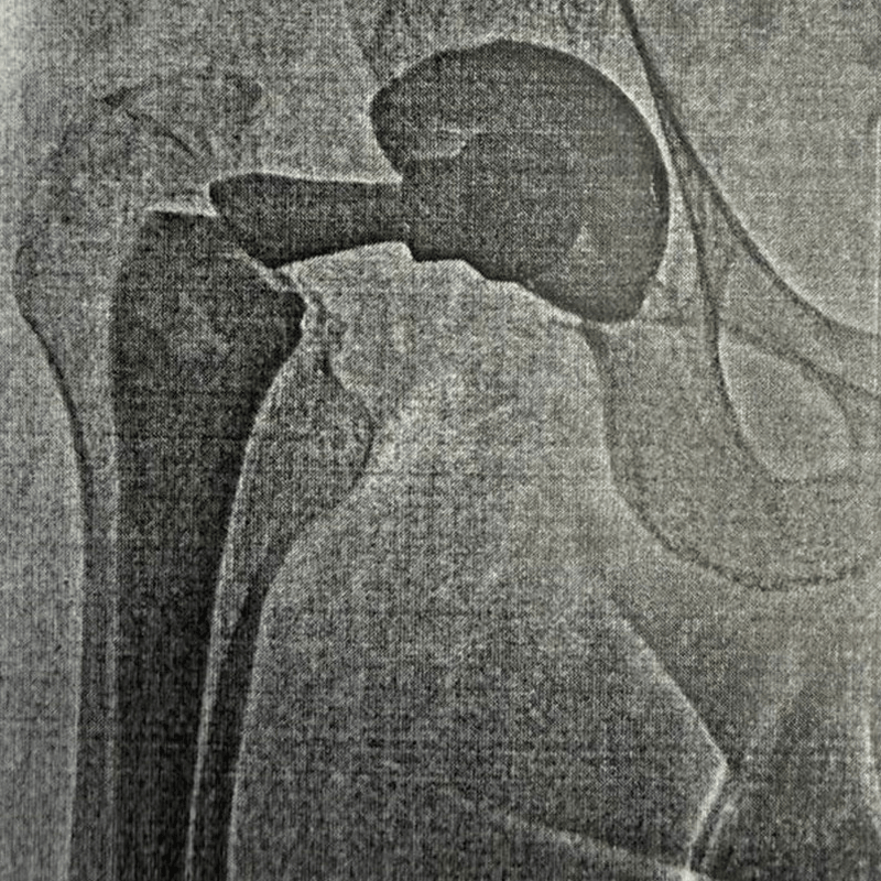 До операции Эндопротезирование 
