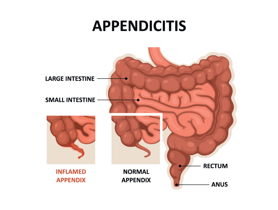 Аппендицит