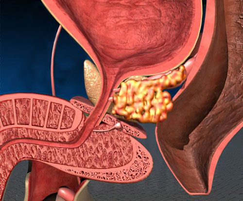 infectia urinara si durerile de spate prostatita în timpul somnului