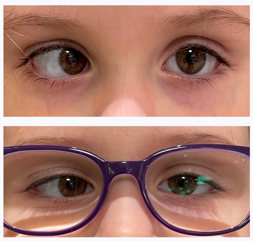 Хирургия частично-аккомодационного косоглазия-1.jpg