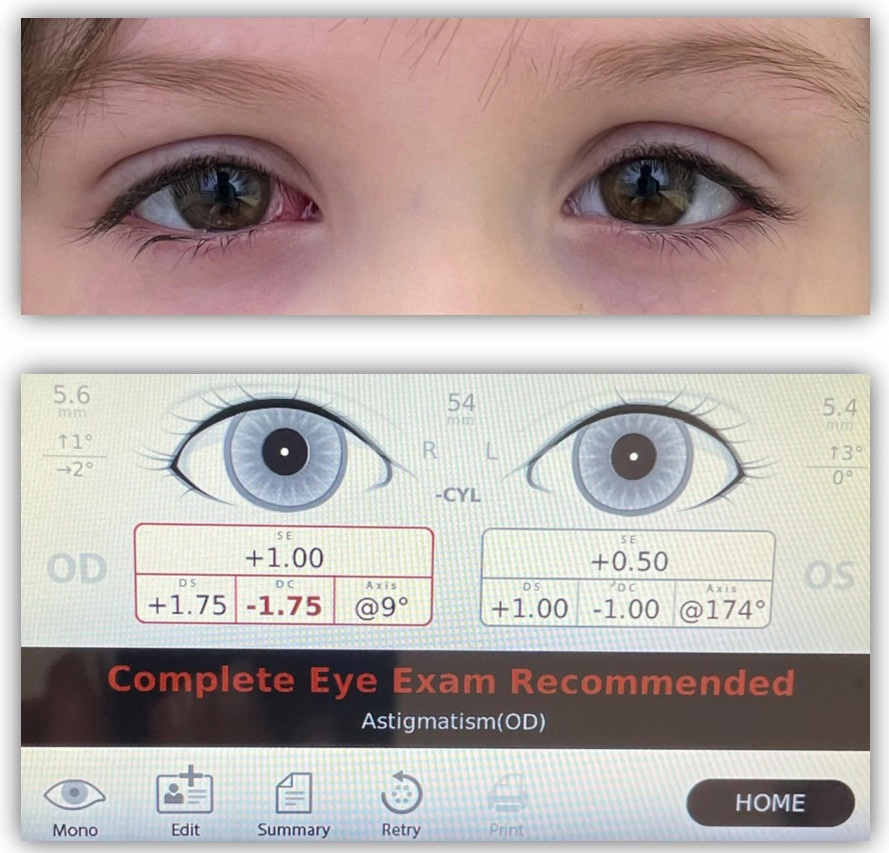 Хирургия частично-аккомодационного косоглазия-4.jpg