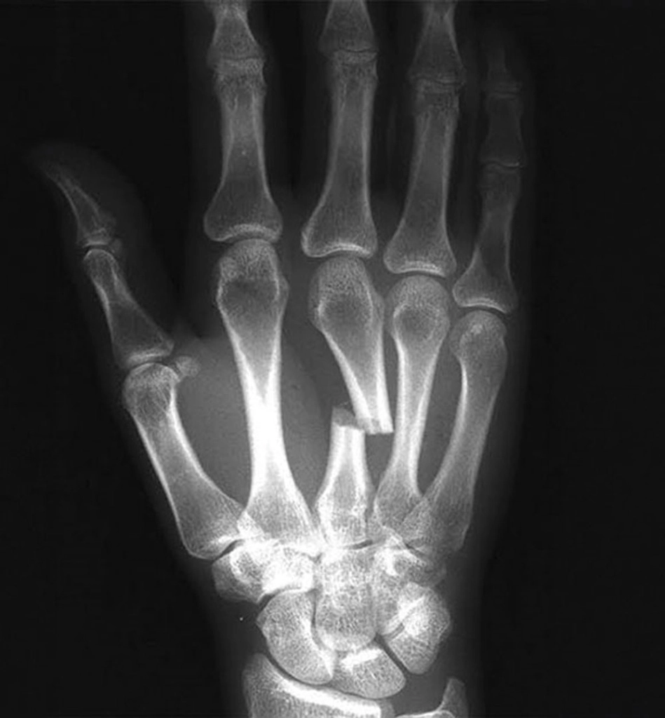 Как восстановить кисть руки после перелома со смещением 2