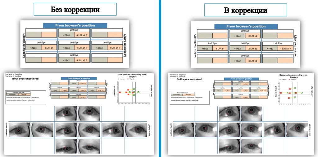 Хирургия частично-аккомодационного косоглазия-2.jpg