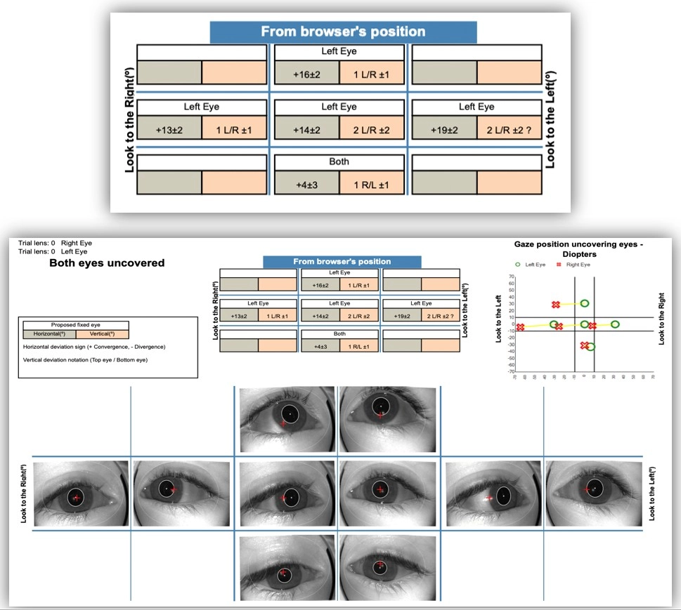 Хирургия частично-аккомодационного косоглазия-3.jpg
