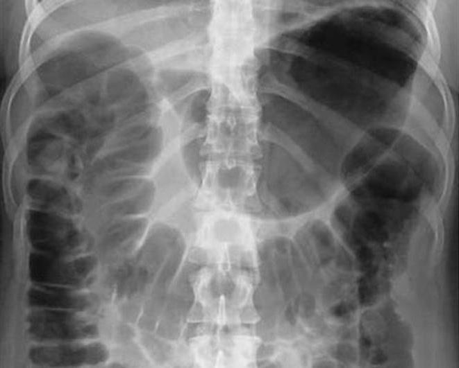 Рентген брюшной полости