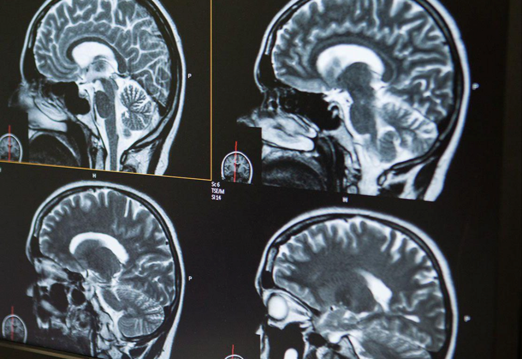 Результаты МР-трактографии: расшифровка