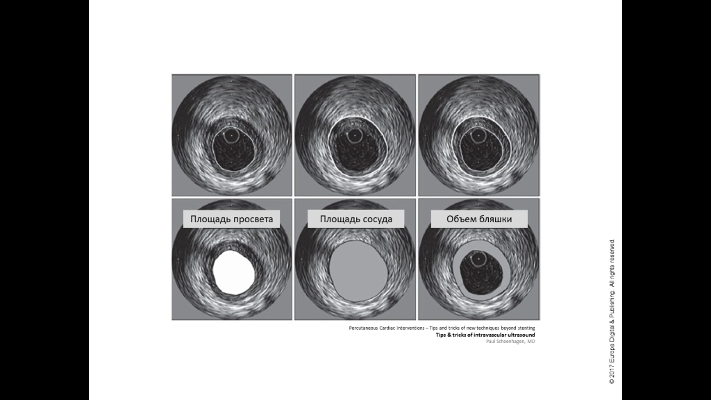 Результат проведения внутрисосудистого ультразвукового исследования коронарной артерии. Определение площади просвета, площади сосуда и объема атеросклеротической бляшки.