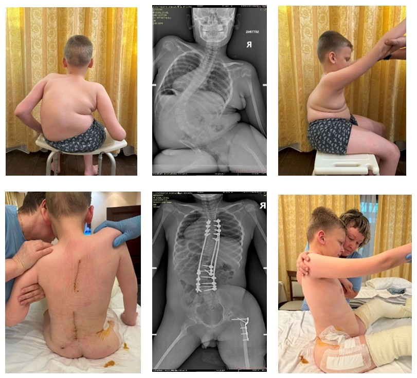 Спинальная мышечная атрофия.jpg