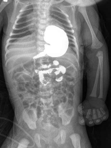 Рентген желудка и пищевода