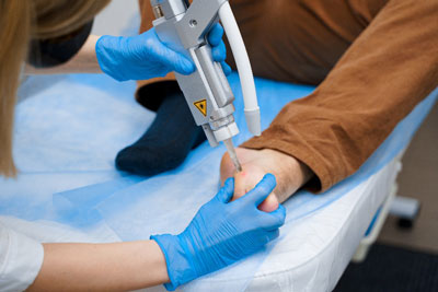 Как лечат подошвенные бородавки