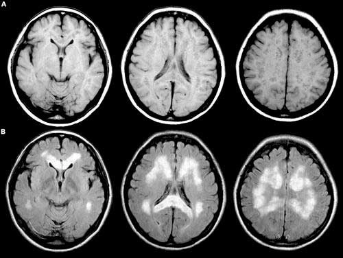 КТ головного мозга с контрастом