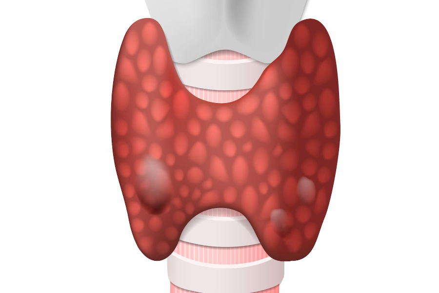 Киста щитовидной железы