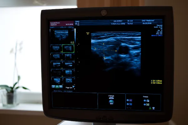 УЗИ сонных артерий УЗИ сонных артерий