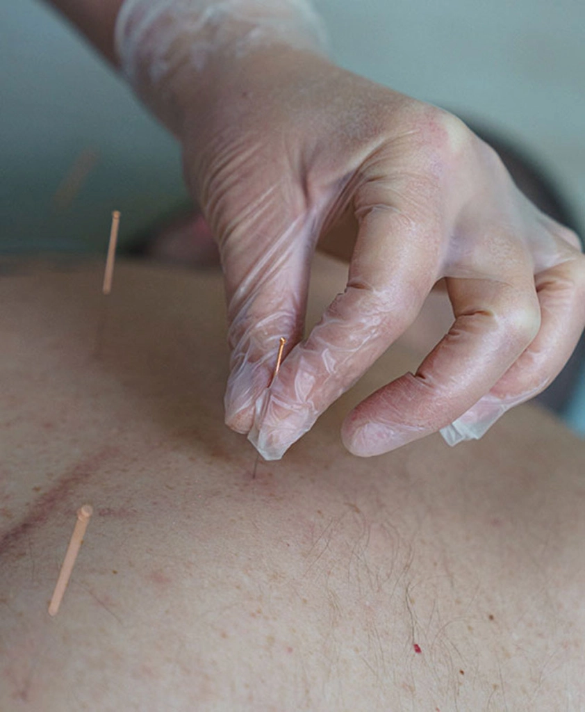 Иглорефлексотерапия – проверенный метод лечения боли в спине 1