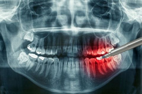 Причины остеомиелита челюсти